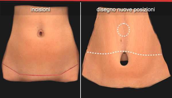 Addominoplastica - Disegno nuove posisizioni: ombelico e taglio pelle