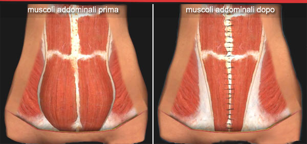 Muscoli addominali prima e dopo addominoplastica. I muscoli addominali vengono serrati mediante cuciture che li avvicina rendendo la parete addominale solida e piatta. 